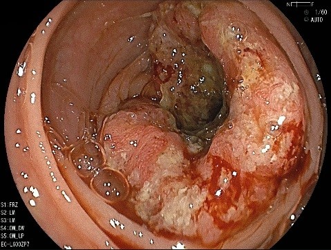 大腸癌の写真