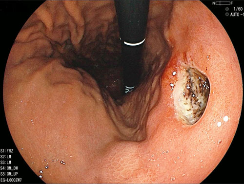 胃潰瘍の症例写真