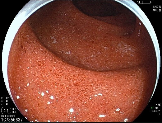 潰瘍性大腸炎の写真