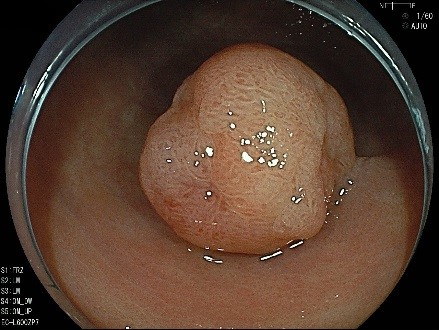 大腸ポリープの写真