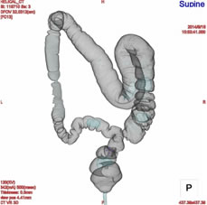 大腸CTの画像例