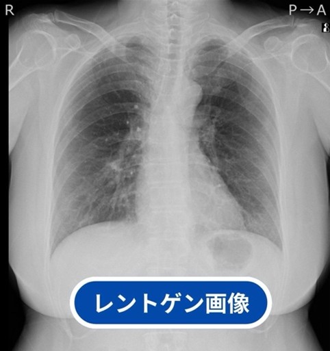 レントゲン診断