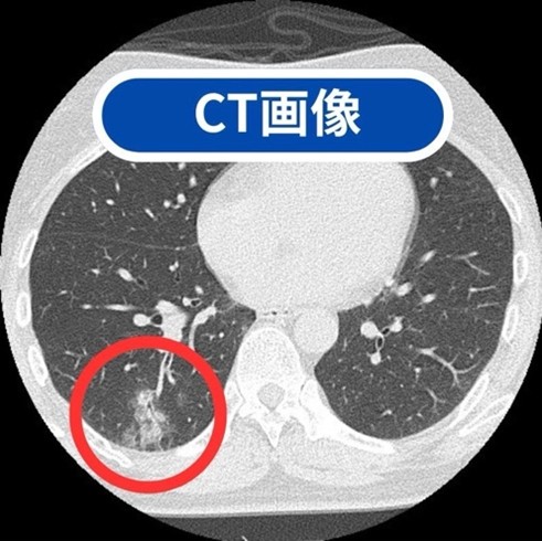 CT画像