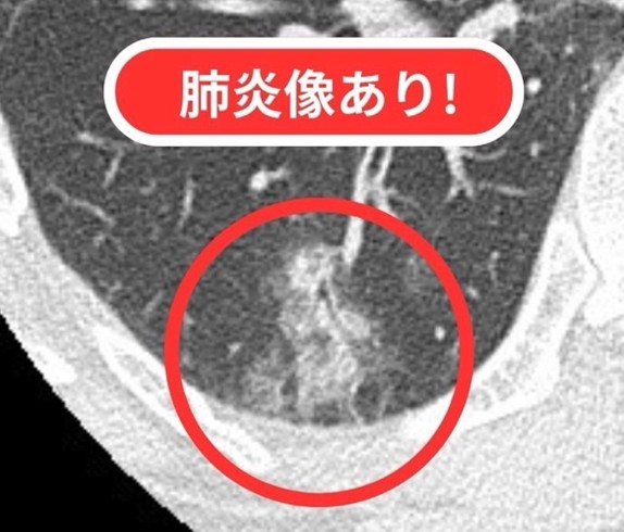 肺炎像あり