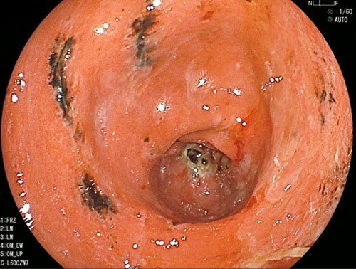 急性胃炎の内視鏡写真