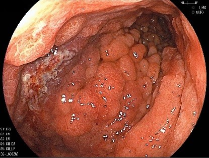 胃がんの内視鏡写真・進行した胃がん