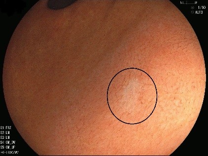 胃がんの内視鏡写真・早期の胃がん