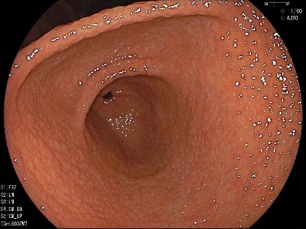 胃がんの内視鏡写真・早期の胃がん
